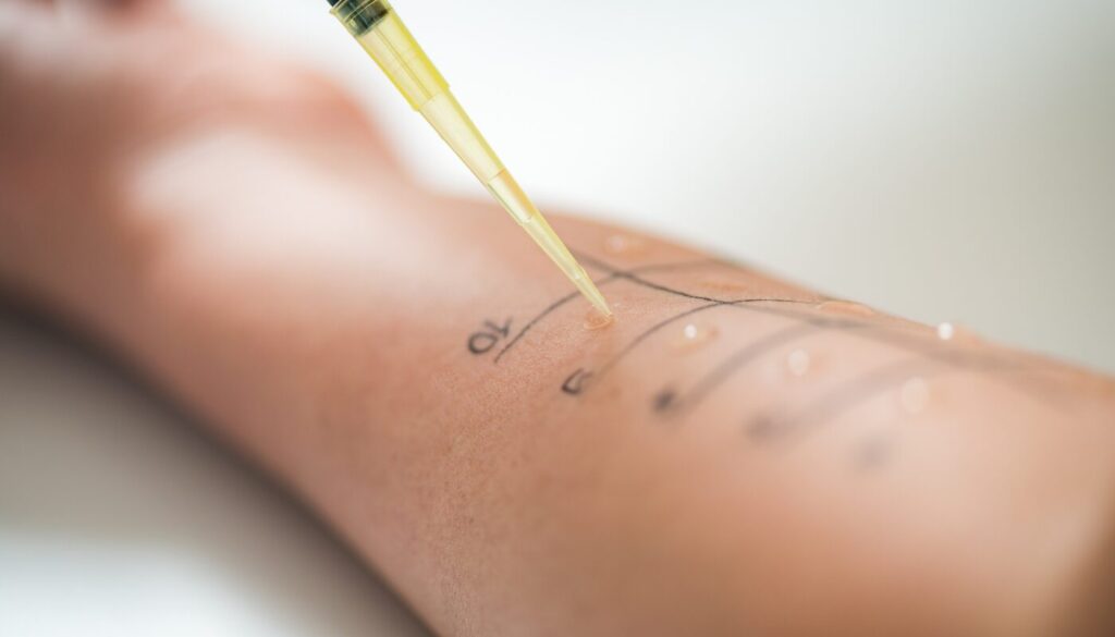 Ein Foto von einem Unterarm, auf dem ein Allergietest in Form eine Pricktests gemacht wird.